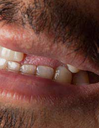 Tooth Loss Dentist Oral Health Lose Gap