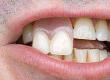 Tooth Loss and General Health