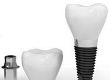 Types of Dental Implant Surgery