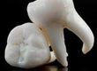 How Tooth Loss Causes Bone Loss